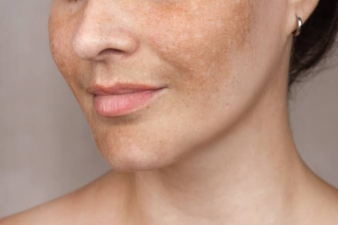 Best Perpigmentation Treatment for Face